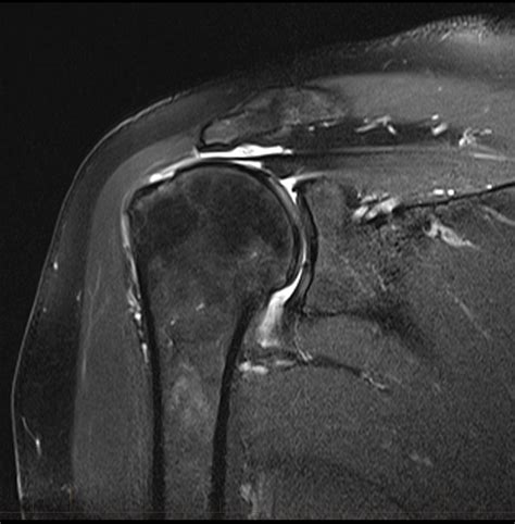 supraspinatus tendon tear results